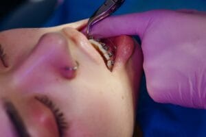 Mujer joven con brackets sonriendo tratamiento de ortodoncia