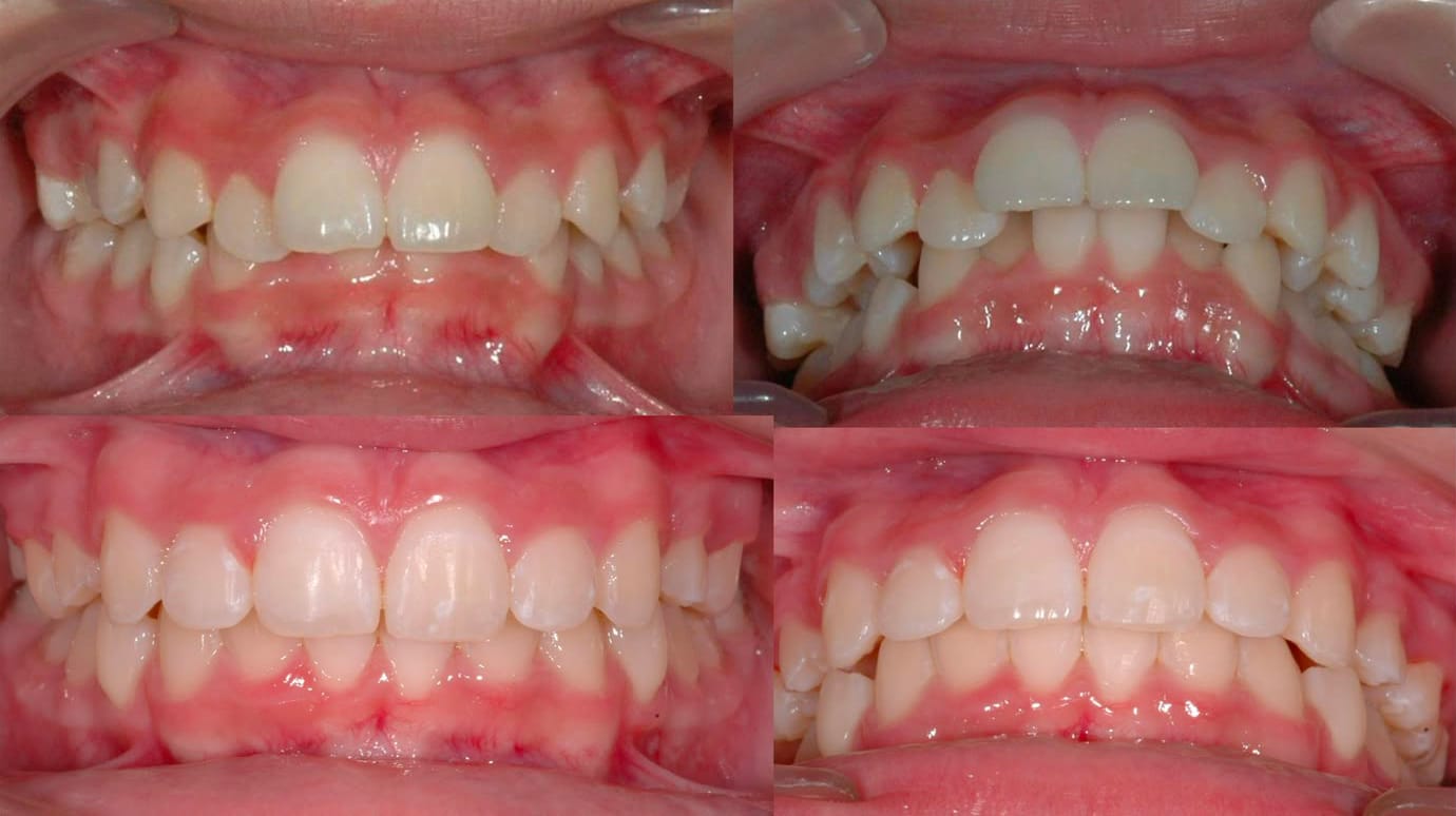 Caso clínico de nivelación gingival