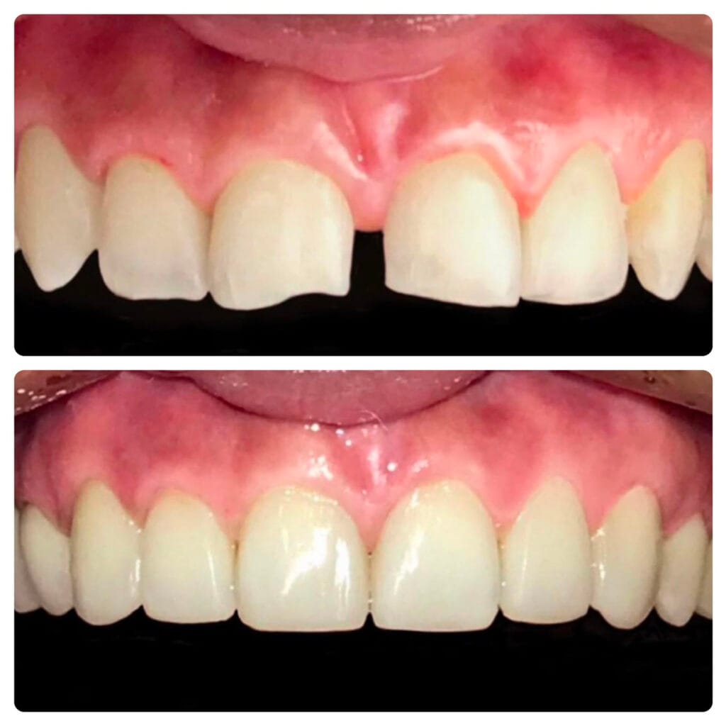 Caso clínico de cierre de diastema entre dientes anteriores