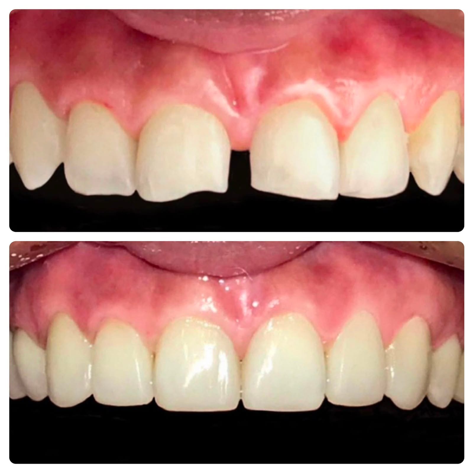 Caso clínico de cierre de diastema