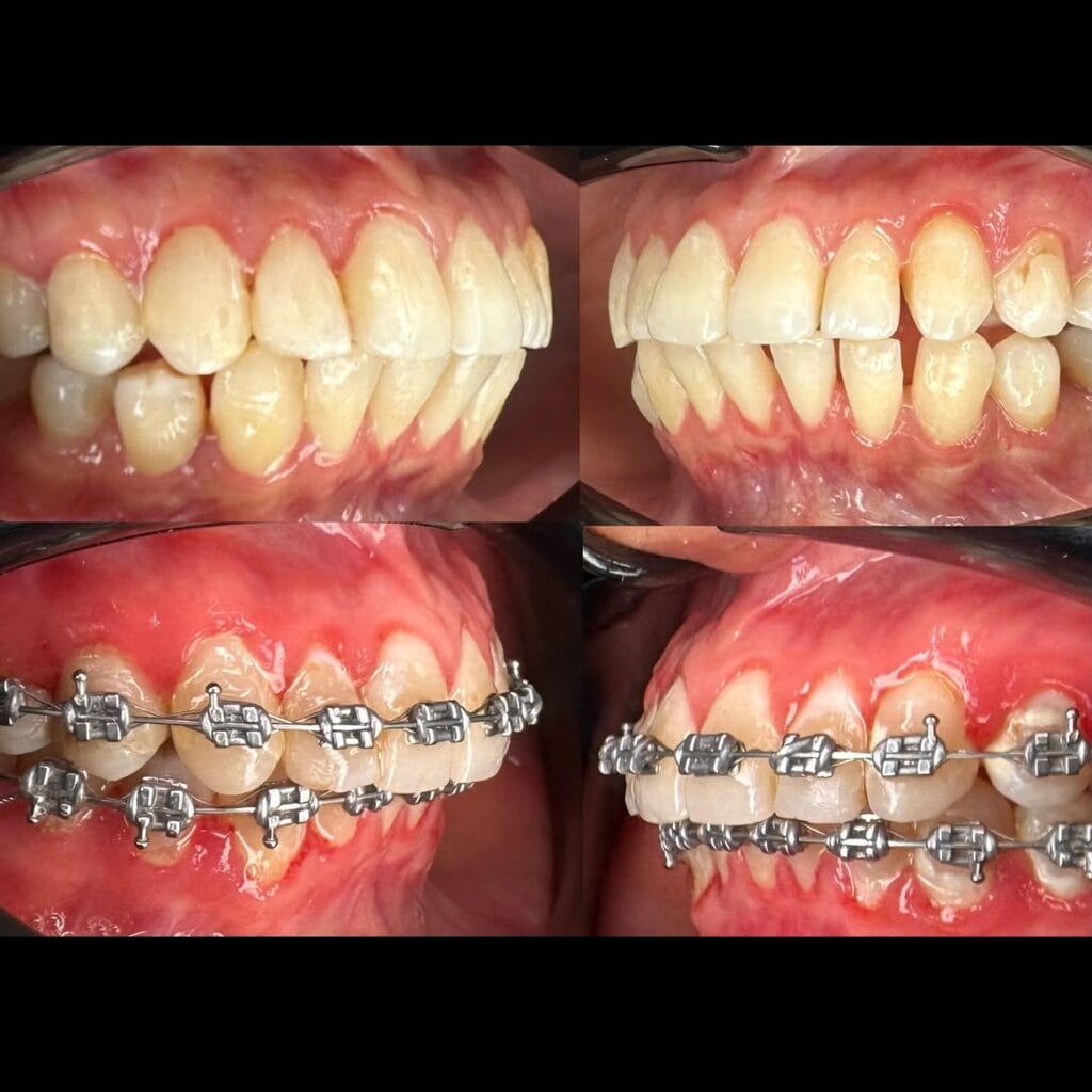 Comparativa antes y después de un tratamiento de ortodoncia.