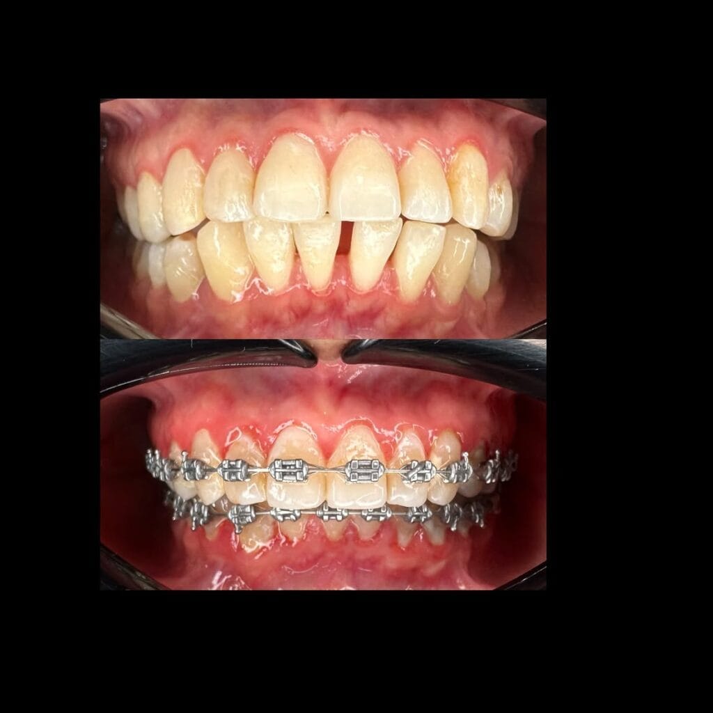 Comparativa de la situación inicial y el inicio de un tratamiento de ortodoncia con brackets.