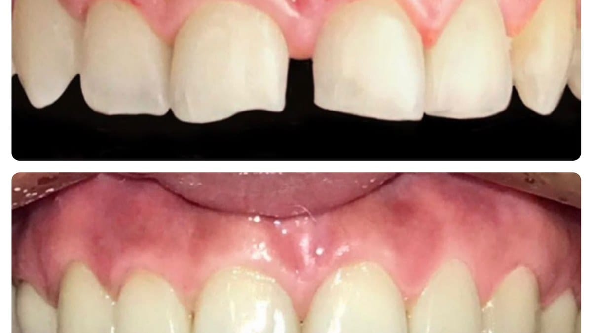 Resultado de tratamiento restaurador y carillas de porcelana en clínica dental Lima